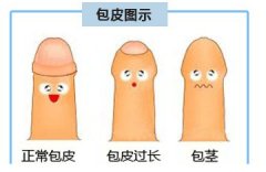 包皮過長“害人害己”
